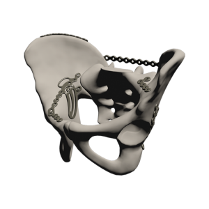 Pelvic Reconstruction System Phoenix (PRSPHX)