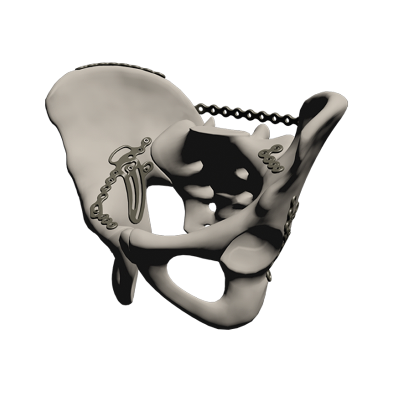 Pelvic Reconstruction System Phoenix (PRSPHX)