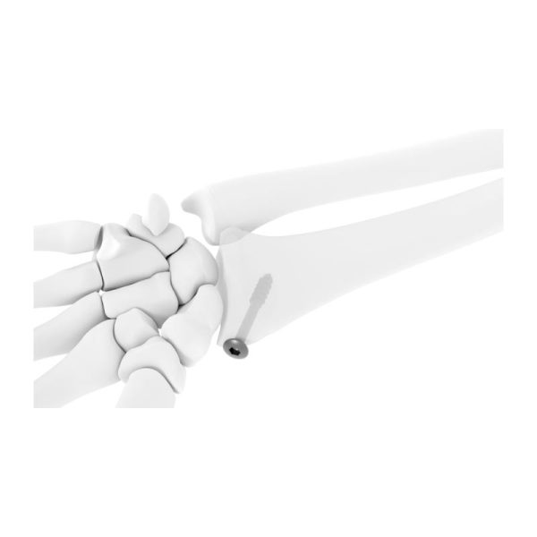 Cannulated Screws (CAS) - Image 3