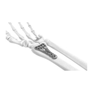 PROlock Radialne (Radius) Zaklepne Plošče (PRLP)