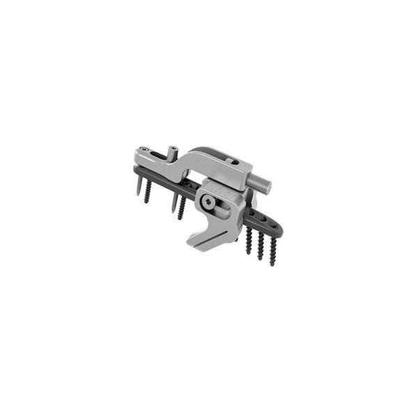Osteotomija podlahtnice II (UOL II) - Image 3
