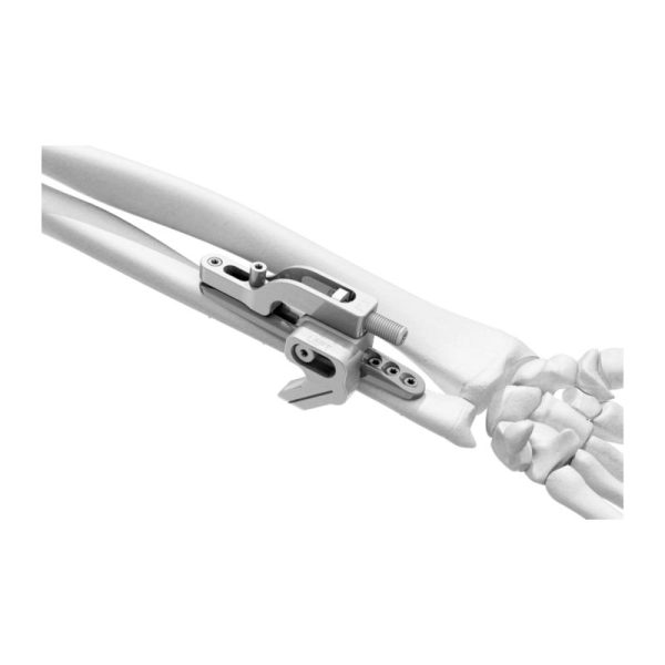 Osteotomija podlahtnice II (UOL II) - Image 4